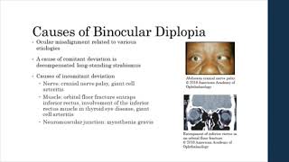 Binocular vs Monocular Diplopia [upl. by Ikila588]