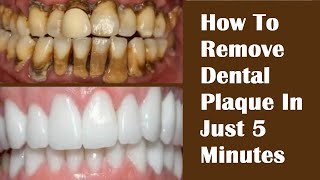 Tartar  Plaque And Calculus Removal From Lower Front Teeth  Dental Scaling On Lower Teeth  Part1 [upl. by Clava]