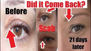 Has Xanthelasma Come Back Before amp After Xanthelasma Removal at Home I show My Scar after Removal [upl. by Lindie]