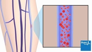 How superficial thrombophlebitis develops [upl. by Sivra]