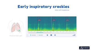 Lung sounds  Early inspiratory crackles [upl. by Noelani589]