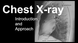 Chest Xray Introduction and Approach [upl. by Reggie]