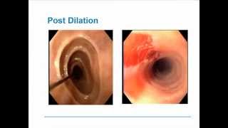 Eosinophilic Esophagitis [upl. by Bortz]