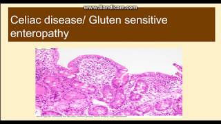 Celiac diseaseGluten Sensitive Enteropathy [upl. by Otir]