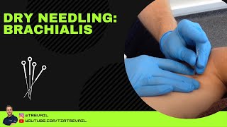 Dry Needling Brachialis [upl. by Inohs]