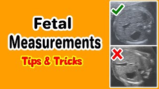 Fetal Measurements Tips and Tricks [upl. by Tutt]