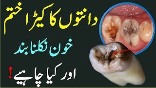 Danton Ka Kera Khatam Karne Ka Ilaj Easy Treatment For Teeth Problems In UrduHindi [upl. by Notsa865]