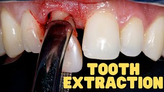 Tooth Extraction Explained  Wisdom Teeth Extraction Aftercare [upl. by Brennan]