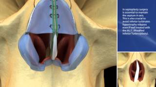 SEPTAL CARTILAGE FLAXATION GOTTARELLI 3GK KNOT [upl. by Esmeralda]