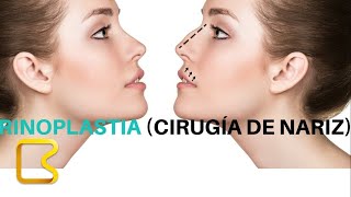 Rinoplastia  cirugía plástica de la nariz [upl. by Dale399]