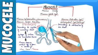 Mucocele  Types Clinical Features Histopathalogic features amp Treatment [upl. by Leahcimaj]