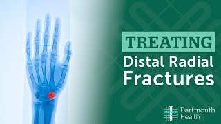 Postdistal radius fracture  conservativelymanaged [upl. by Feerahs352]