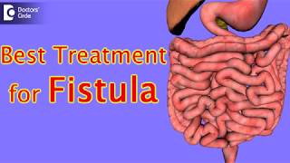 Perianal Fistula Causes Symptoms Treatment Urdu Hindi  Bhagandar Ka Ilaj How To Treat Fistula [upl. by Ijat808]