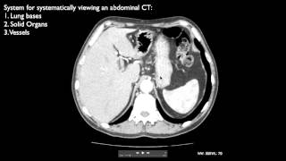 How to interpret an abdominal CT [upl. by Kcirdneked]