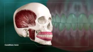 Bruxism Clenching and Grinding [upl. by Rodi]