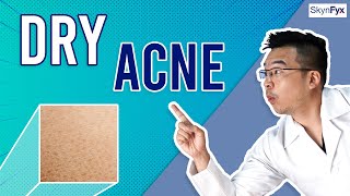 How To Treat Dry Skin  Acne Dry Acne  5 Tips To Follow [upl. by Raseta]