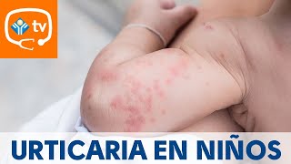 Urticaria en niños ¿cómo se produce ¿Tiene importancia [upl. by Nat]