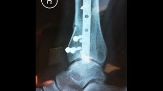 Recovery from Fractured Ankle ORIF Surgery Distal Tibia Broken Fracture Part 2 [upl. by Samuel667]