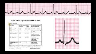 How to Determine Intervals amp Segments on EKG EXPLAINED [upl. by Gill]