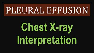 Pleural Effusion  Chest Xray Interpretation [upl. by Munn472]