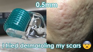 I tried dermarolling my ACNE SCARS  Demo  Review [upl. by Alin]