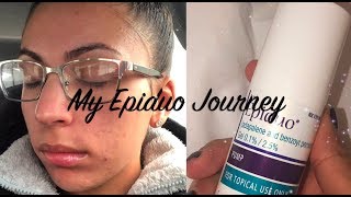 My Epiduo Journey Weeks 12 [upl. by Enyawad]