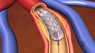 PCI Percutaneous Coronary Intervention  Primary Angioplasty [upl. by Stockton648]