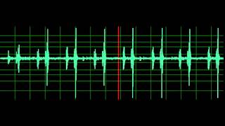 Pulmonary Associated Heart Sounds PAH Split S2 [upl. by Suoicserp]