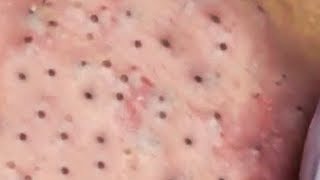 How To Remove Blackheads And Whiteheads On Face Easy 97 ✦ Dr Laelia ✦ [upl. by Kolosick]