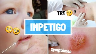 IMPETIGO  CAUSES  SYPMTOMES  COMPLICATIONS  TRAITEMENT [upl. by Culbertson]