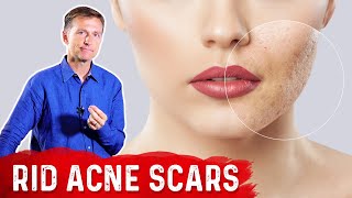 Best Way to Rid Acne Scars [upl. by Nellir]