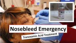 Nosebleed Emergency and Tranexamic Acid Treatment [upl. by Chasse]