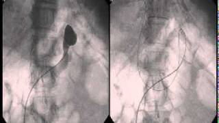 Balloon Retrograde Transvenous Occlusion BRTO [upl. by Jairia]