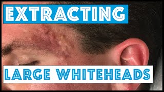 Acne Vulgaris and Extracting large Whiteheads  Part 1 [upl. by Vine]