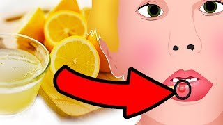 Natural Cures for Mucocele Mucous Cyst  How I treat it [upl. by Olive960]