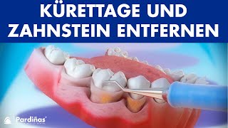 Parodontosebehandlung  Kürettage und Zahnstein entfernen © [upl. by Atirres]