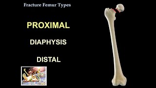 Fracture Femur Types  Everything You Need To Know  Dr Nabil Ebraheim [upl. by Beret]