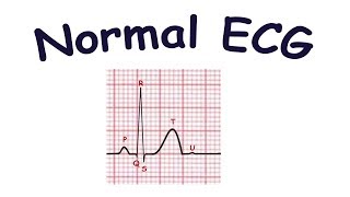 Normal ECG [upl. by Neerehs]