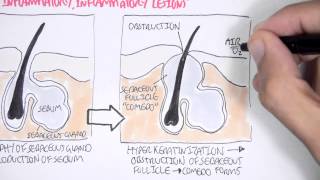 Acne Pathophsyiology [upl. by Studner]