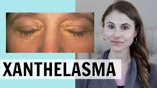 XANTHELASMA WHAT IT IS amp HOW IT IS TREATED DR DRAY [upl. by Aiynot]