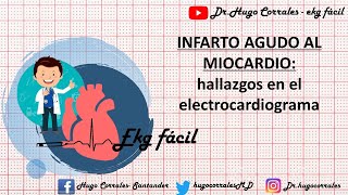 INFARTO AGUDO DE MIOCARDIO Hallazgos electrocardiográficos [upl. by Onibas768]