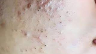 New blackheads BYoungSpa [upl. by Nagaer]