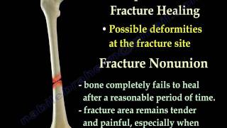 Fracture Healing Part 1  Everything You Need To Know  Dr Nabil Ebraheim [upl. by Meier]