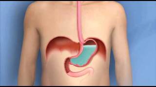 Swallowing Disorders and Achalasia [upl. by Ingham]