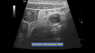 Mesenteric Vascular Occlusion  Ultrasound Case  GIT [upl. by Ahtela130]