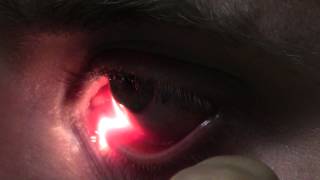 Ophthalmic Skills Video  Basics in Slit Lamp Examination [upl. by Alieka]