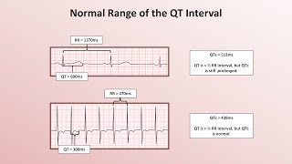 Advanced EKGs  The QT Interval and Long QT Syndrome [upl. by Aniez]