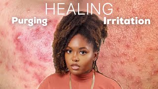 PURGING OR IRRITATION  Esthetician Explains How to Identify and Treat Both Conditions [upl. by Erdnassac62]