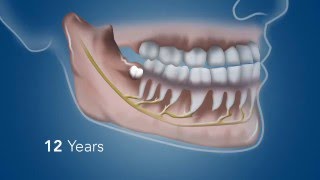 Wisdom teeth [upl. by Philo]