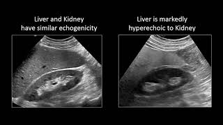 GI Imaging  Hepatic Steatosis and Cirrhosis [upl. by Uolyram]